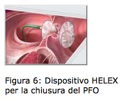 Chiusura percutanea del forame ovale pervio (pfo)